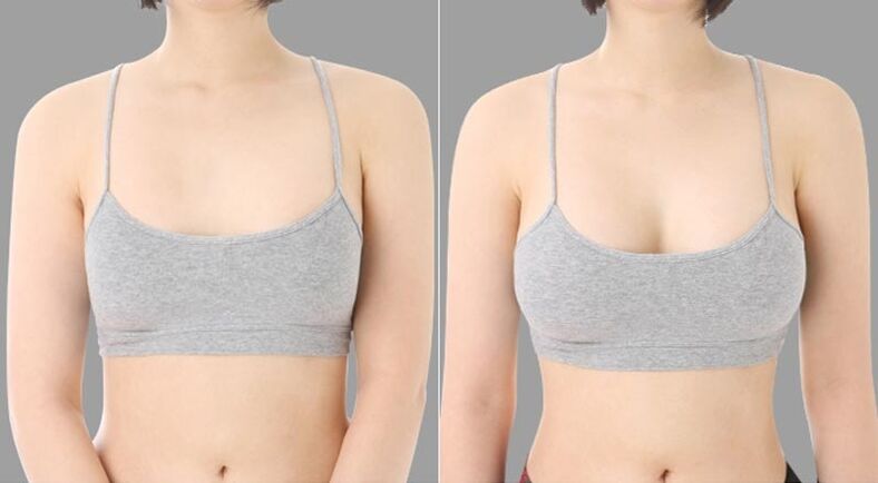 przed i po powiększeniu piersi
