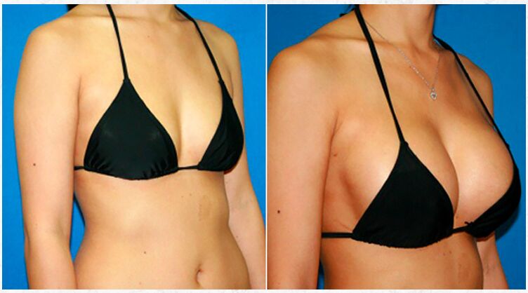 Przed i po powiększeniu piersi chirurgią plastyczną