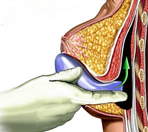 implantacja w celu powiększenia piersi