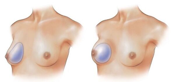 implanty w kształcie kropli i okrągłe do powiększania piersi