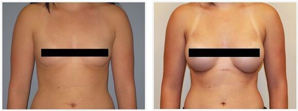piersi przed i po operacji