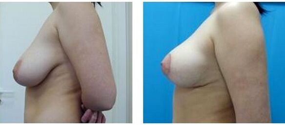 przed i po operacji powiększenia piersi