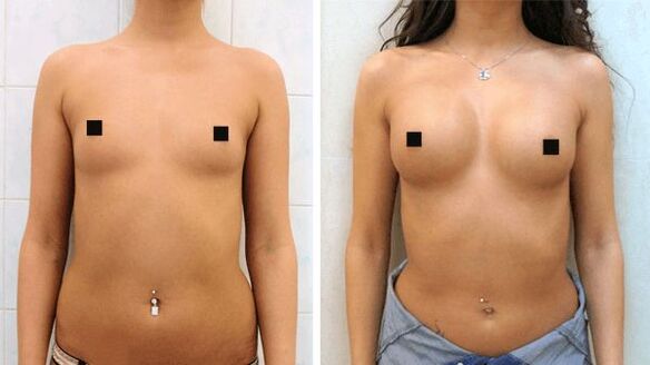 zdjęcia przed i po operacji powiększenia piersi