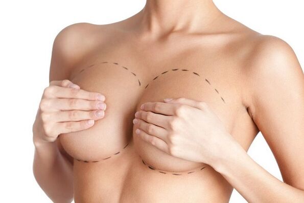 znaczniki do operacji powiększania piersi