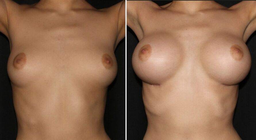 Przed i po zabiegu powiększania piersi